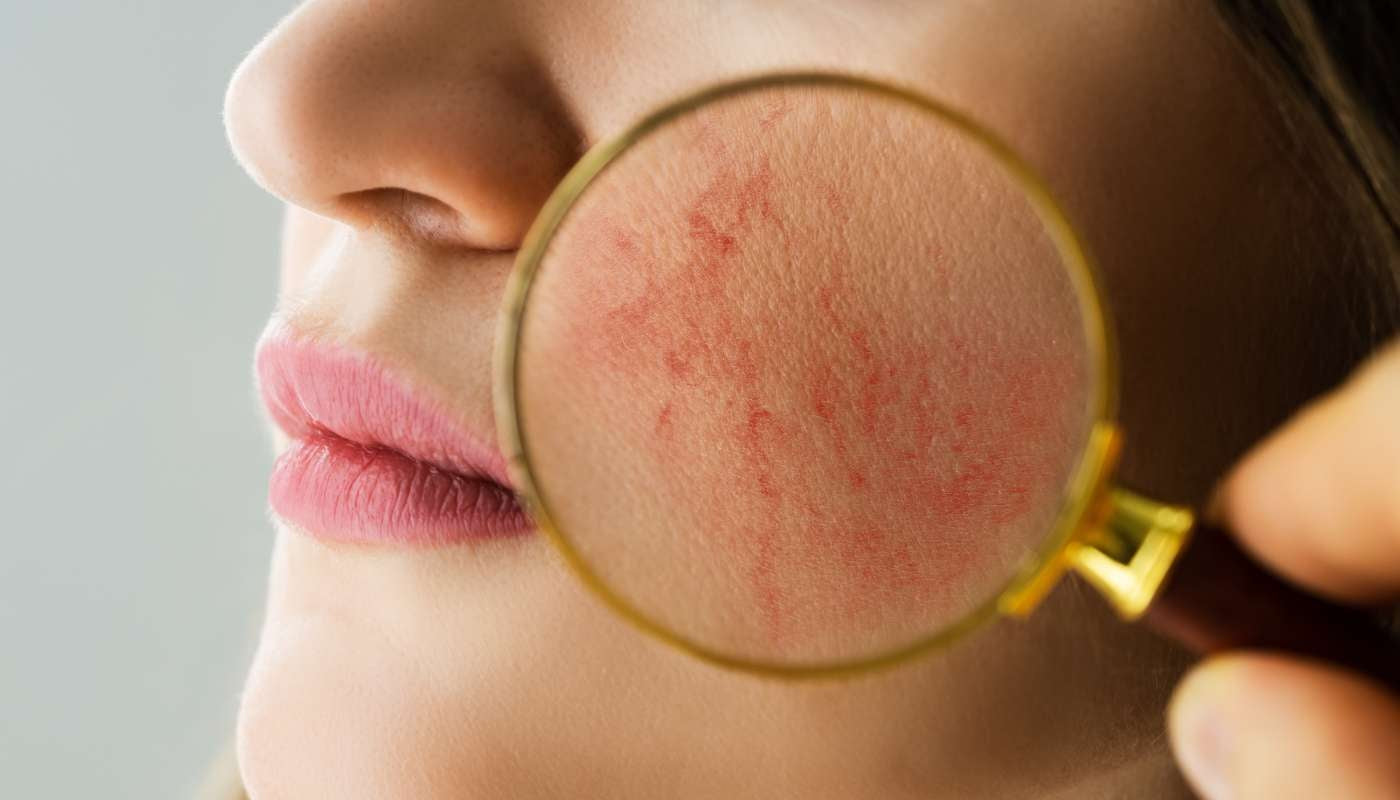 Rosacea: What Is It? What Causes It? (And How To Tell If You Have It)-Hello-Charlie