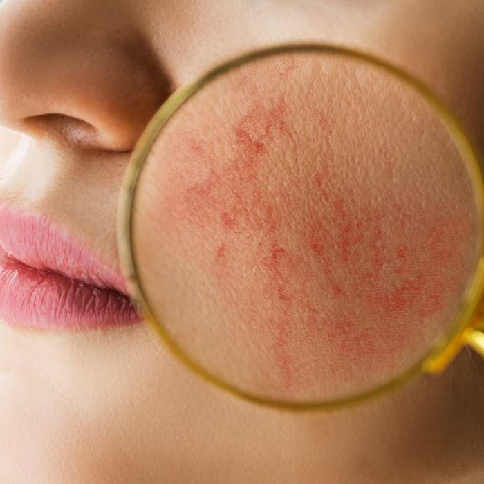 Rosacea: What Is It? What Causes It? (And How To Tell If You Have It)-Hello-Charlie