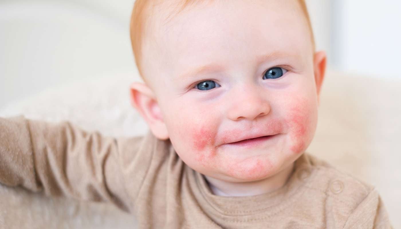 How to Treat Eczema and Dermatitis Naturally - Hello Charlie