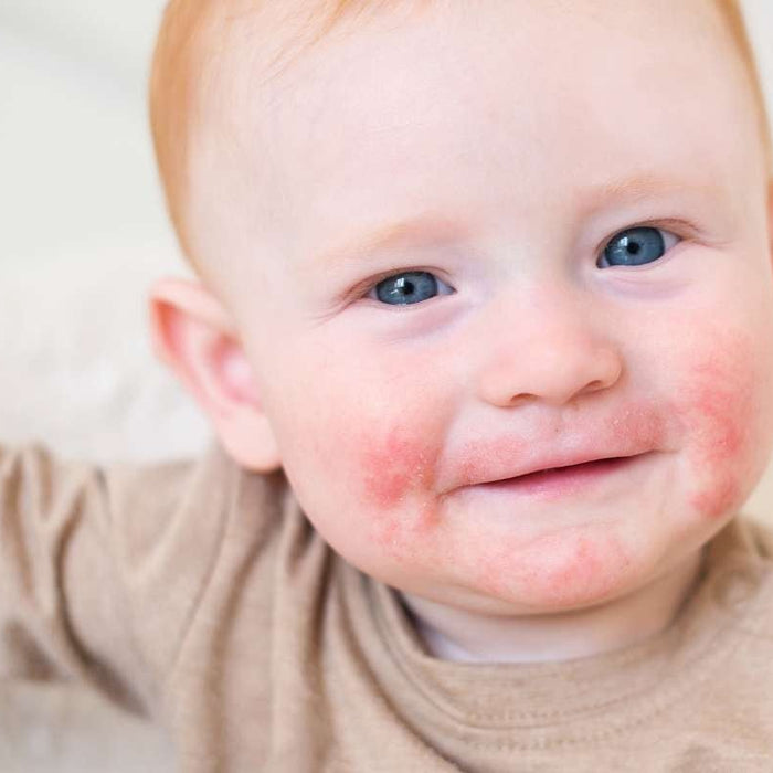How to Treat Eczema and Dermatitis Naturally - Hello Charlie