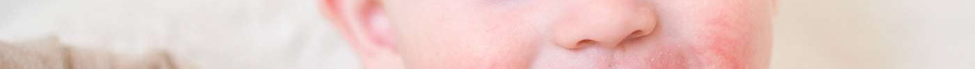 How to Treat Eczema and Dermatitis Naturally - Hello Charlie