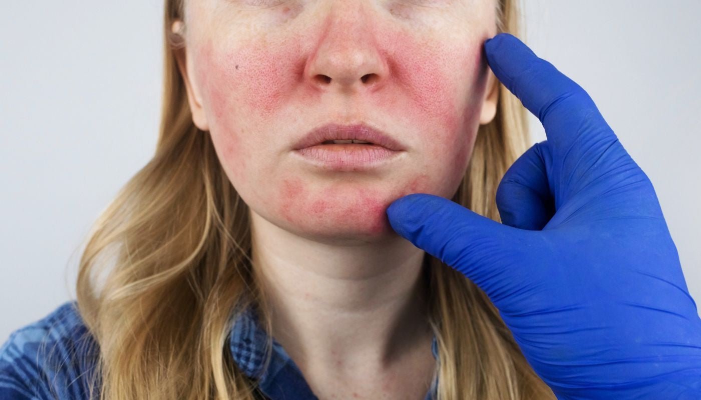 Rosacea Treatments: How To Fight Flare Ups Naturally - Hello Charlie