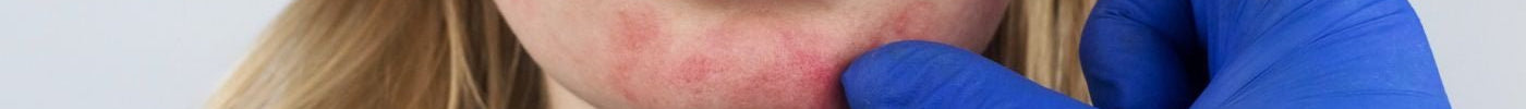 Rosacea Treatments: How To Fight Flare Ups Naturally - Hello Charlie