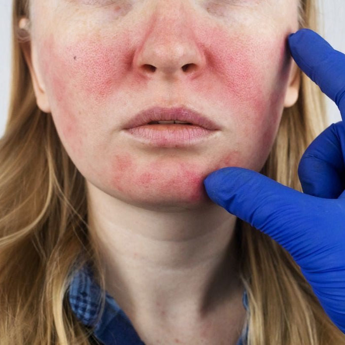 Rosacea Treatments: How To Fight Flare Ups Naturally - Hello Charlie
