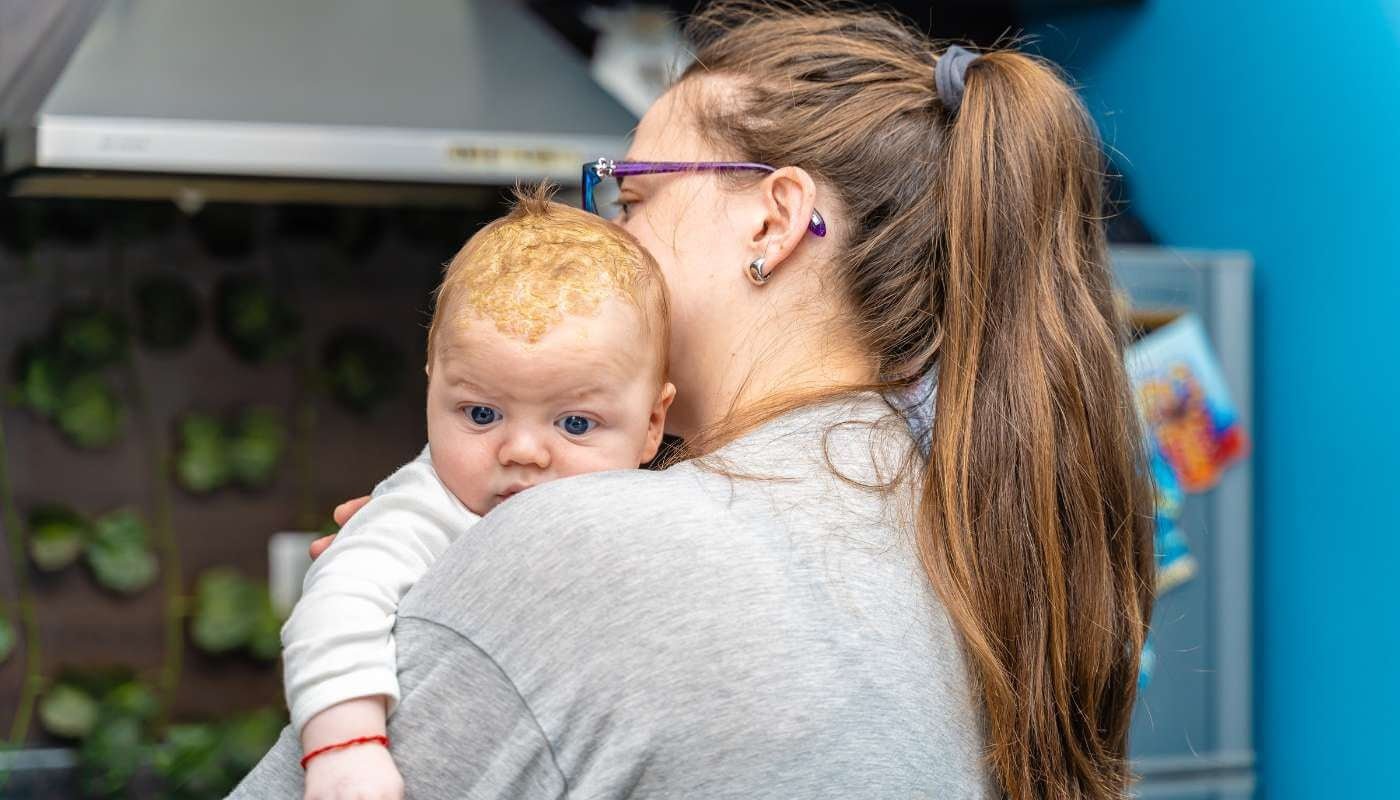 The Complete Beginner's Guide to Cradle Cap - Hello Charlie